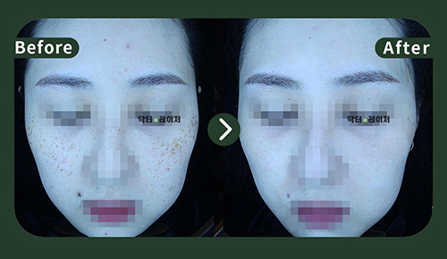 [주근깨] 30대 젼후사진