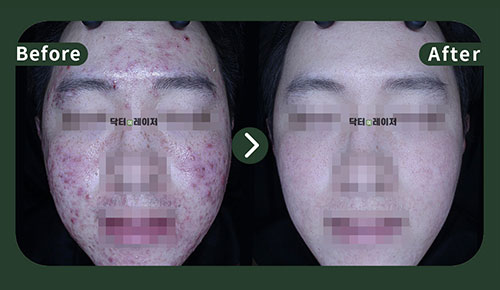 [여드름] 20대 전후사진