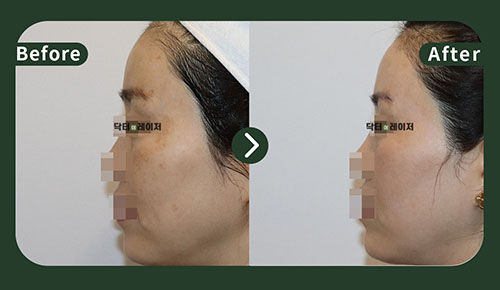 [기미/리프팅] 50대 전후사진