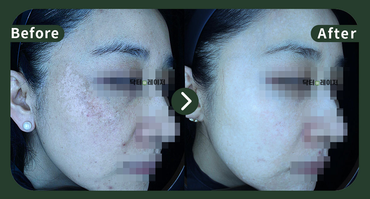 기미 특화치료 | 닥터이레이저피부과